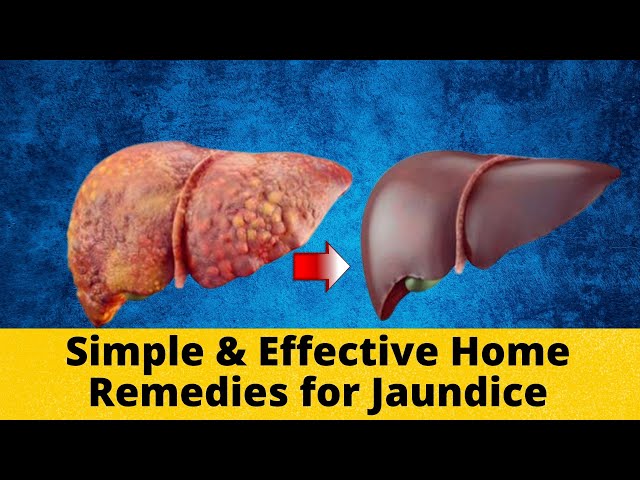 Natural Remedies for Jaundice