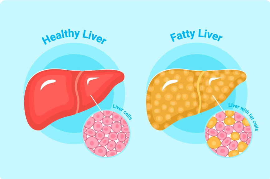 The image illustrates the difference between a healthy liver and a fatty liver, also known as steatosis. Fatty liver disease occurs when there is excess fat buildup in the liver.